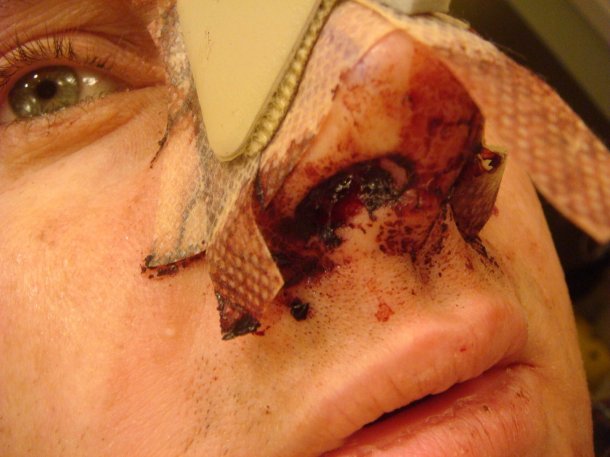 rock climbing accident