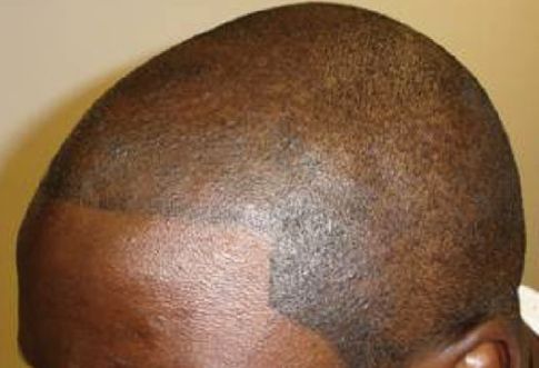 Tattooed hair.  A good hair loss strategy?