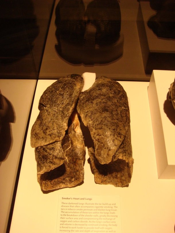 bodyworlds-smokers-lungs